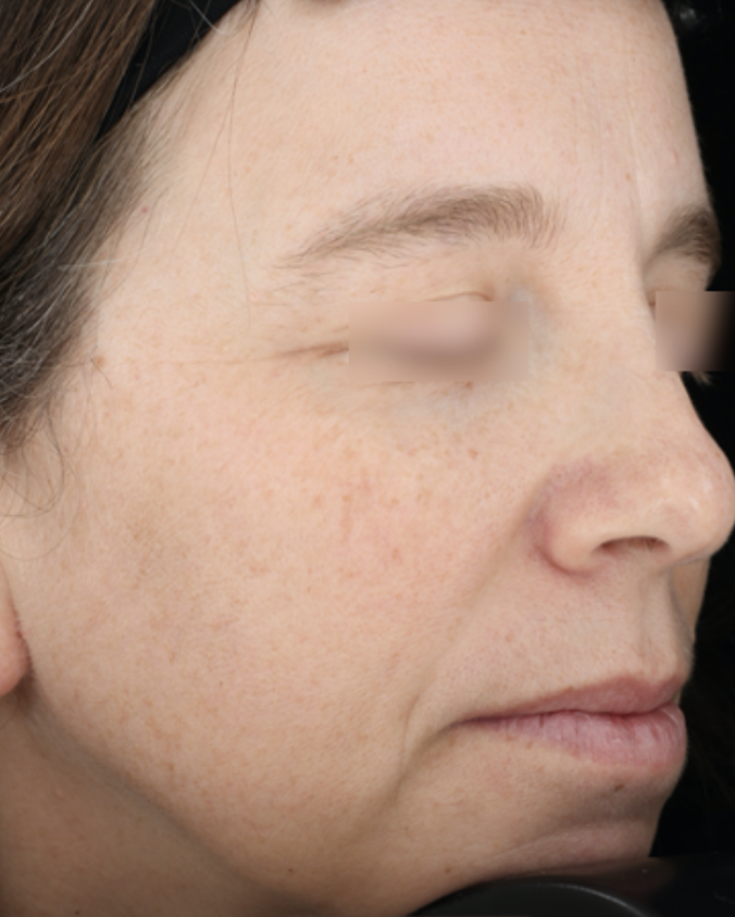 After: 1 Month Post 1 Treatment